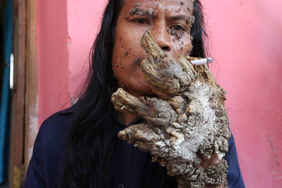 На 42 году жизни в Индонезии скончался человек-дерево Деде Косвара
