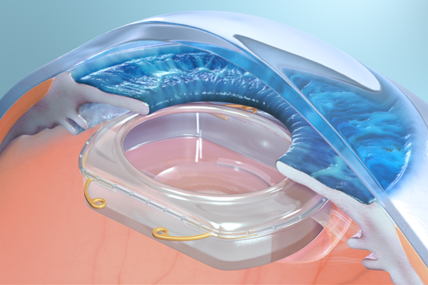 Omega Ophthalmics планирует устанавливать AR-импланты прямо в глаза