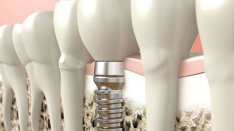 Имплантаты Nobel – выбор разумного стоматолога